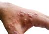 CDC Finds Monkeypox Virus Survives On Household Items and Surfaces