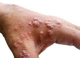 CDC Finds Monkeypox Virus Survives On Household Items and Surfaces